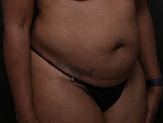 Tummy Tuck with Contouring: Case 9 - Before