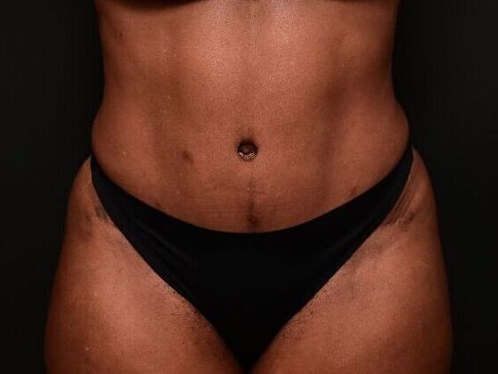 Tummy Tuck with Contouring: Case 9 - After