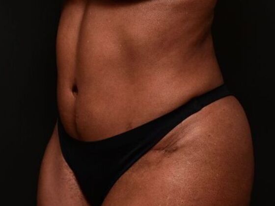 Tummy Tuck with Contouring: Case 9 - After