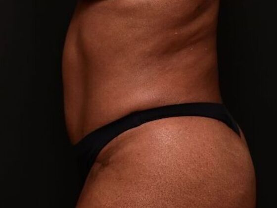 Tummy Tuck with Contouring: Case 9 - After