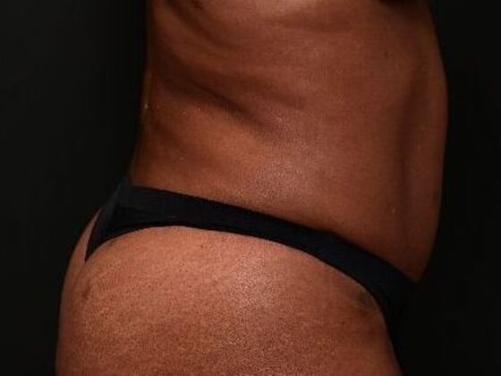 Tummy Tuck with Contouring: Case 9 - After