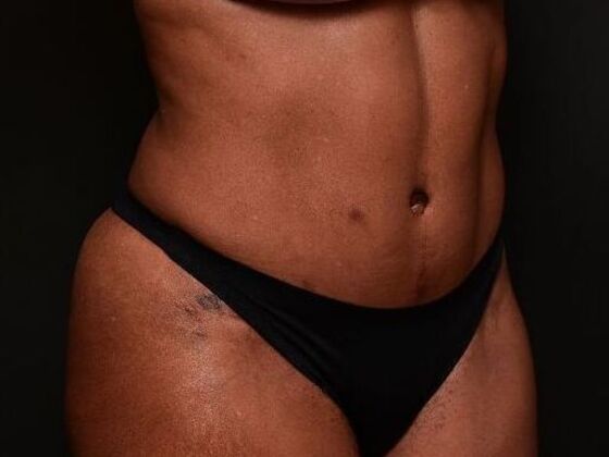 Tummy Tuck with Contouring: Case 9 - After