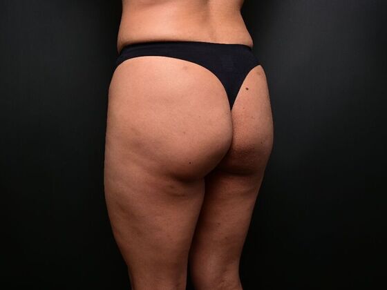 Brazilian Butt Lift: Case 7 - After