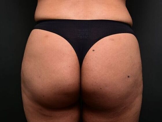 Brazilian Butt Lift Case 7 - After