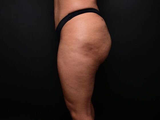 Brazilian Butt Lift: Case 7 - Before