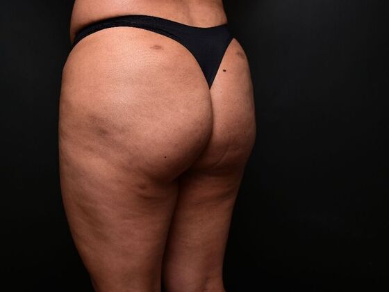 Brazilian Butt Lift: Case 7 - Before