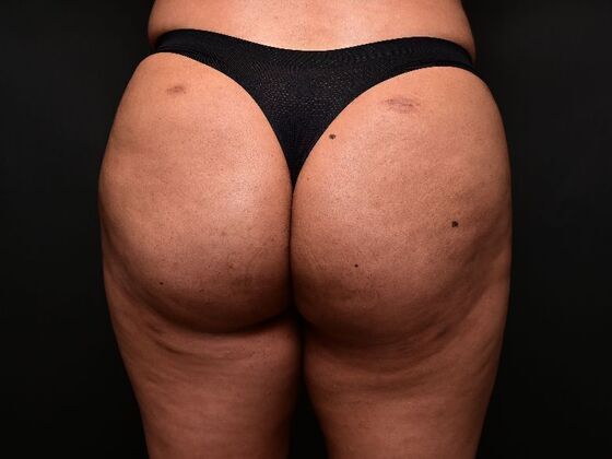 Brazilian Butt Lift Case 7 - Before