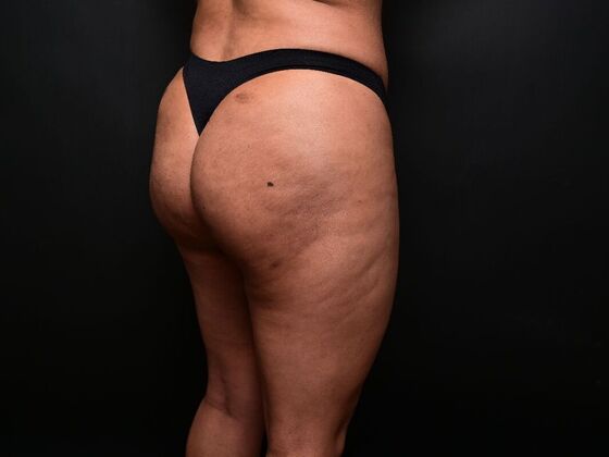 Brazilian Butt Lift: Case 7 - Before