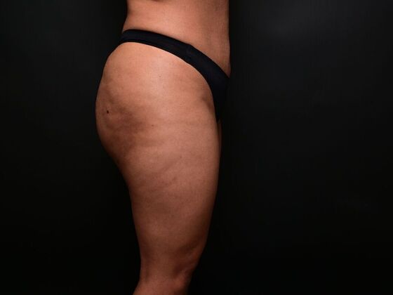 Brazilian Butt Lift: Case 7 - Before