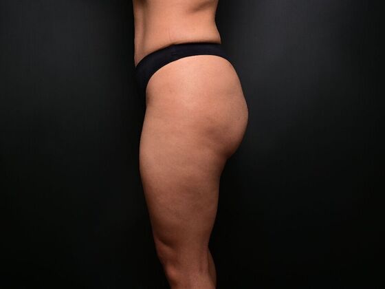 Brazilian Butt Lift: Case 7 - After