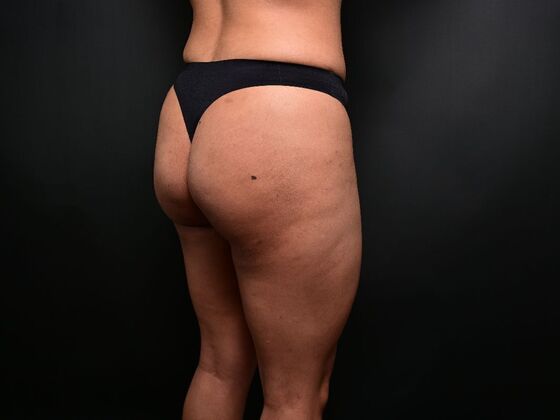 Brazilian Butt Lift: Case 7 - After