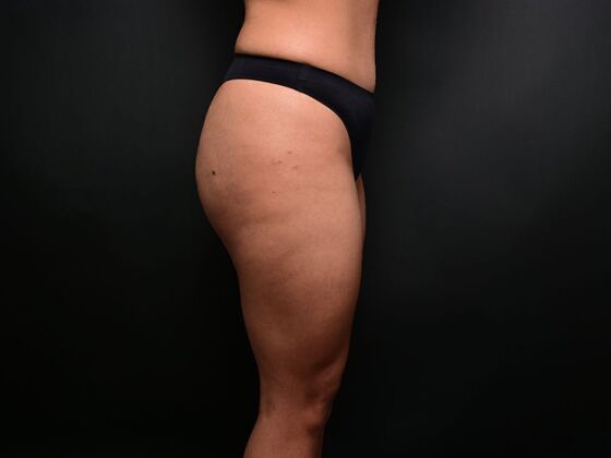 Brazilian Butt Lift: Case 7 - After