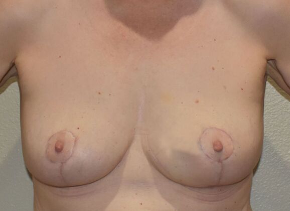 Breast Implant Removal: Case 59 - After