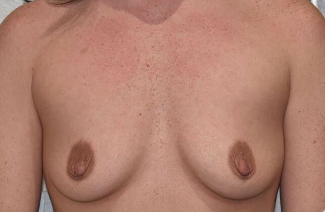 Breast Augmentation Case 9 - Before