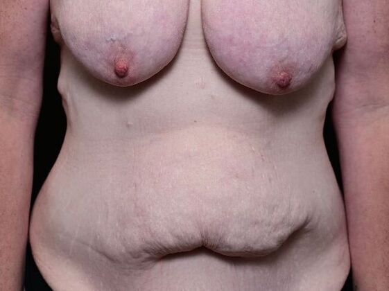 Liposuction Case 2 - Before