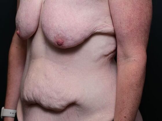 Liposuction: Case 2 - Before
