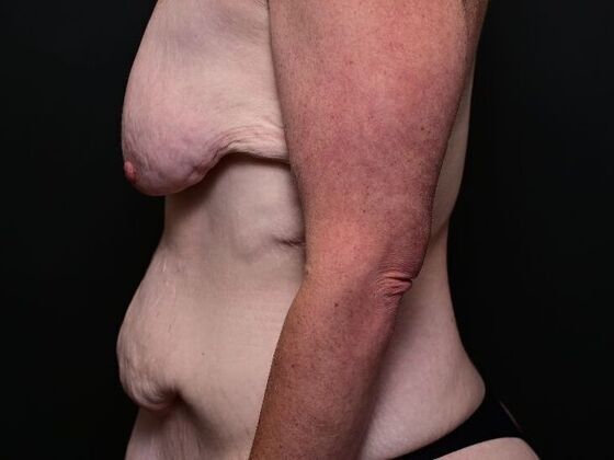 Liposuction: Case 2 - Before