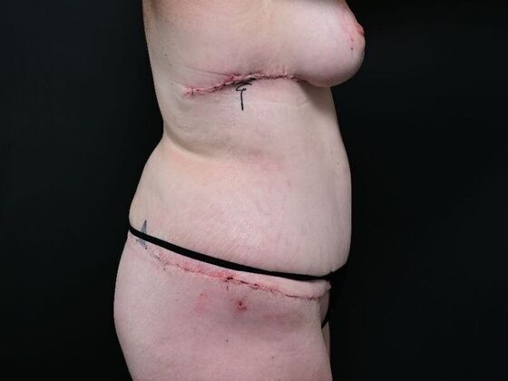 Liposuction: Case 2 - After