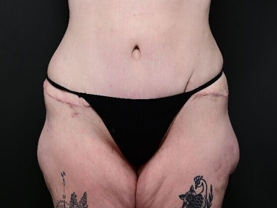 Liposuction Case 2 - After
