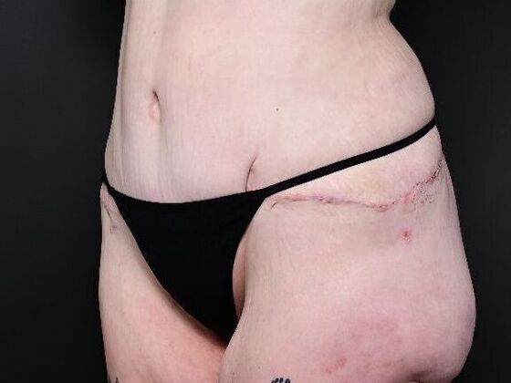 Liposuction: Case 2 - After