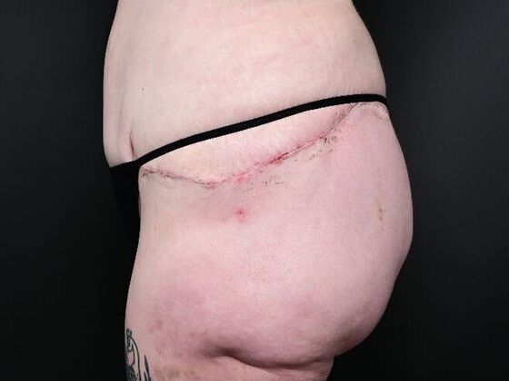 Liposuction: Case 2 - Before