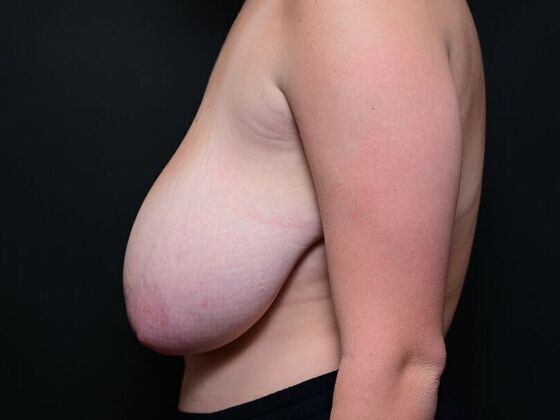 Breast Reduction: Case 8 - After