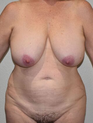 Mommy Makeover Case 343 - Before