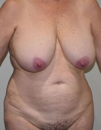 Mommy Makeover: Case 343 - Before