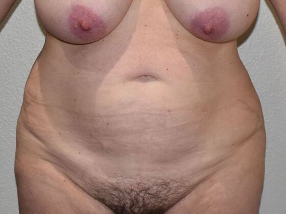 Tummy Tuck (Abdominoplasty): Case 548 - Before