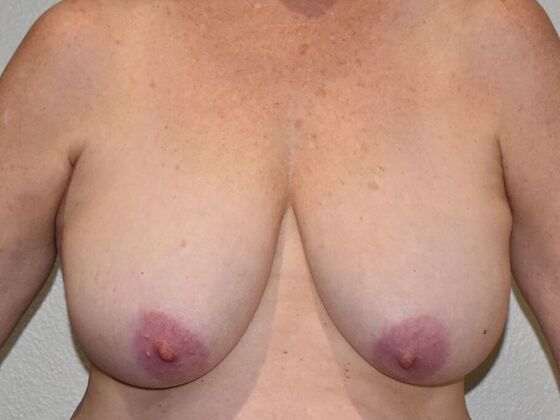 Breast Reduction: Case 200 - Before
