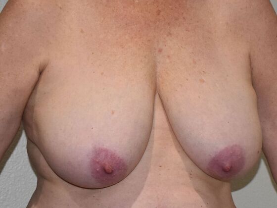 Breast Reduction: Case 200 - Before