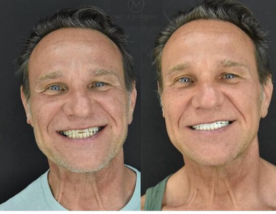 Smile Makeover Case