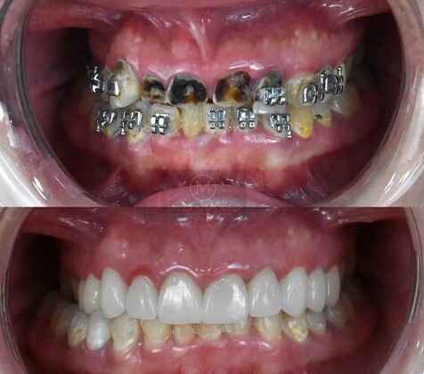 Dental Crowns Case