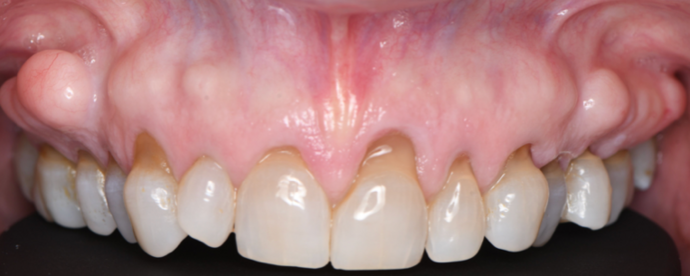 Periodontics Cases by Dr. Yamen Akhras Case 1 - Soft Tissue - Before