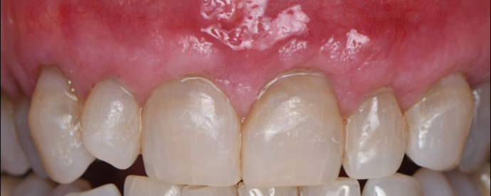 Periodontics Cases by Dr. Yamen Akhras Case 1 - Soft Tissue - After