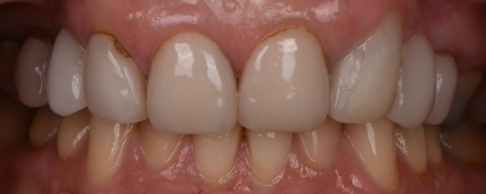 Periodontics Cases by Dr. Yamen Akhras Case 2 - Crown Lengthening - Before