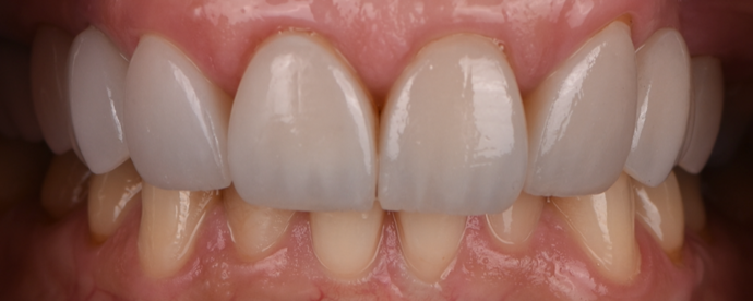 Periodontics Cases by Dr. Yamen Akhras Case 2 - Crown Lengthening - After