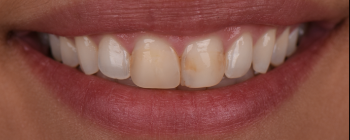 Periodontics Cases by Dr. Yamen Akhras Case 3 - Crown Lengthening - Before