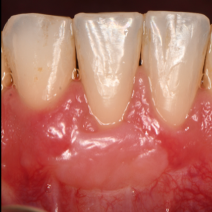 Periodontics Cases by Dr. Yamen Akhras Case 4 - Soft Tissue - After
