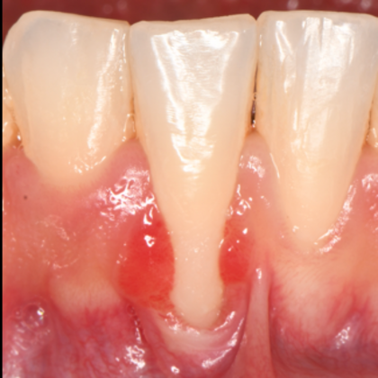 Periodontics Cases by Dr. Yamen Akhras Case 4 - Soft Tissue - Before