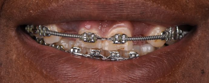 Dental Implants Cases by Dr. Yamen Akhras Case 1 - Before