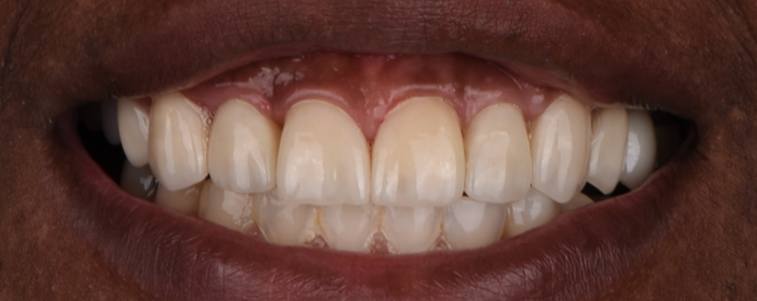 Dental Implants Cases by Dr. Yamen Akhras Case 1 - After