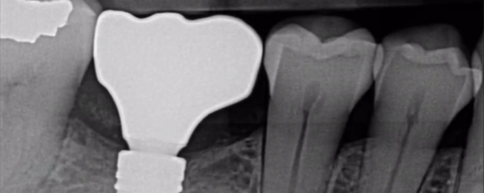 Dental Implants Cases by Dr. Yamen Akhras Case 2 - Before