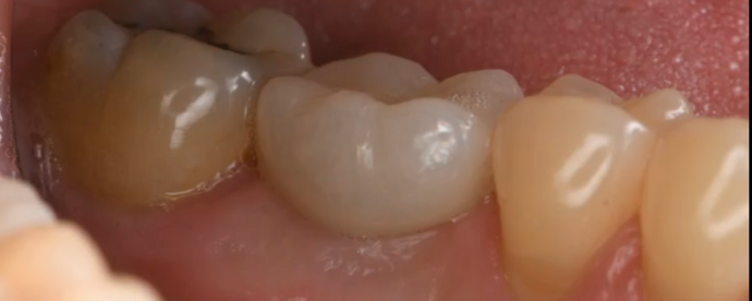 Dental Implants Cases by Dr. Yamen Akhras Case 2 - After