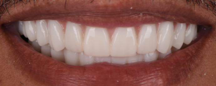 Full Mouth Reconstruction Cases by Dr. Yamen Akhras Case 1 - After