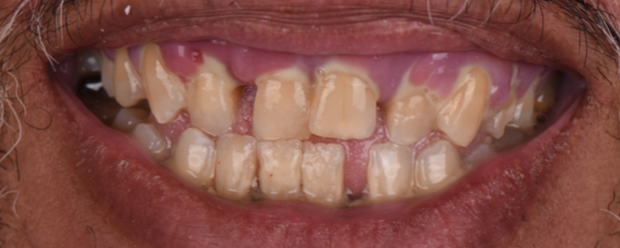 Full Mouth Reconstruction Cases by Dr. Yamen Akhras Case 1 - Before