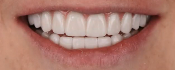 Full Mouth Reconstruction Cases by Dr. Yamen Akhras Case 2 - After