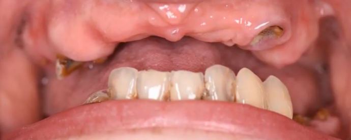 Full Mouth Reconstruction Cases by Dr. Yamen Akhras Case 2 - Before