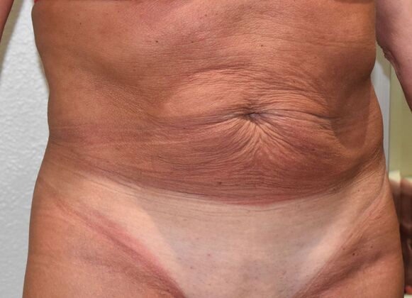 Tummy Tuck (Abdominoplasty): Case 549 - Before