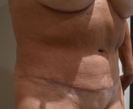 Tummy Tuck (Abdominoplasty): Case 549 - After
